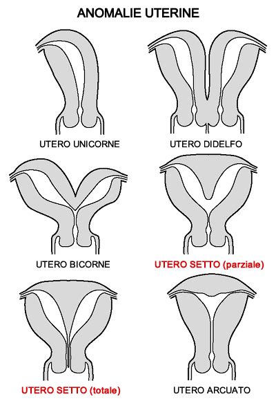 Immagine di utero setto