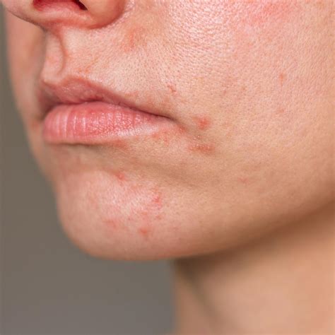 Dermatite periorale nel neonato
