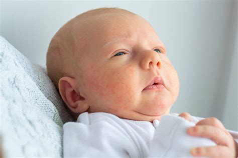 Localizzazioni comuni di eczema nei bambini