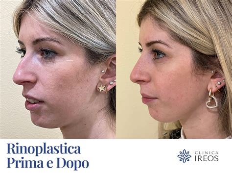 immagini comparative prima e dopo la regressione dei peli nel neonato
