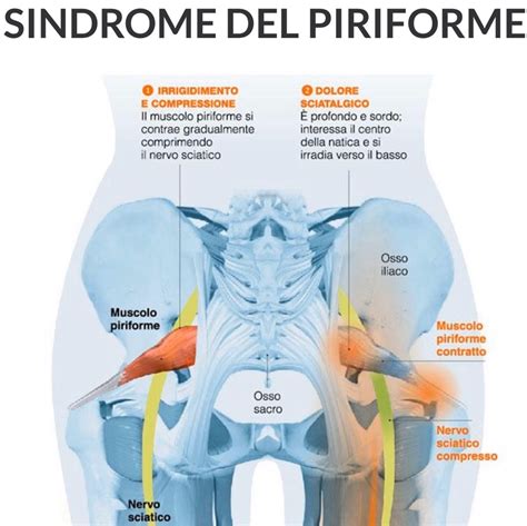 Processo diagnostico per la sindrome del piriforme