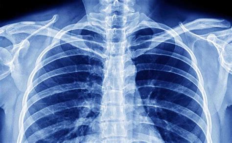 radiografia del torace con evidenza di infiltrati da meconio