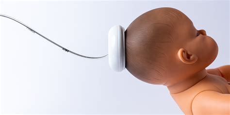 Schema di un parto operativo con ventosa ostetrica