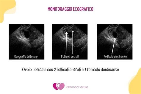 Monitoraggio ecografico follicoli ovarici
