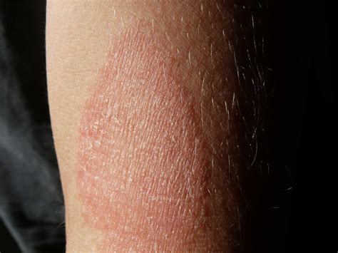 Dermatite allergica da contatto su un braccio con arrossamento e vescicole