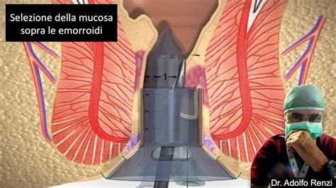 confronto tra diverse tecniche chirurgiche per emorroidi