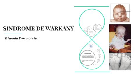schema dei tratti del volto associati alla sindrome di Warkany 2