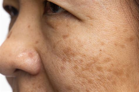 Immagine di una persona con melasma sul viso