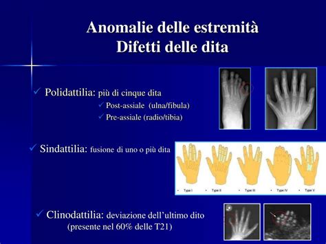 Illustrazione delle diverse anomalie delle dita: polidattilia, sindattilia, clinodattilia, ectrodattilia