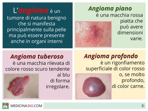 Schema che illustra le differenze tra angioma superficiale e profondo