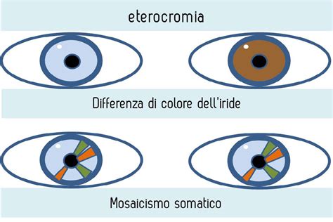 Eterocromia negli occhi