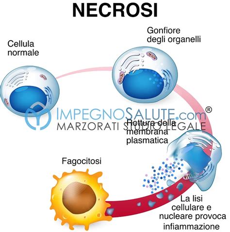 placenta con aree di necrosi