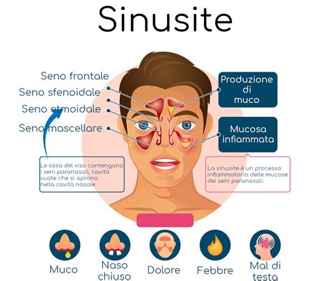 Cause della sinusite