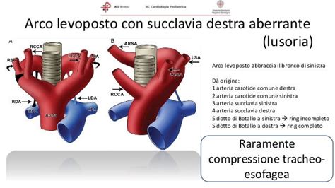 Schemi di Doppio Arco Aortico e Arco Aortico Destro con Legamento Arterioso Retroesofageo