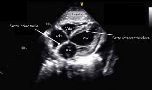 diagramma delle 4 camere cardiache fetali visualizzabili in ecografia