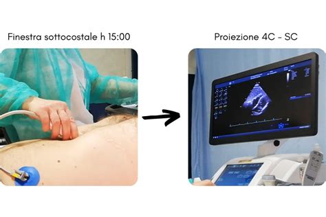 rappresentazione grafica del posizionamento della sonda ecografica sull'addome materno