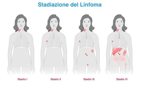 Illustrazione del linfoma di Hodgkin