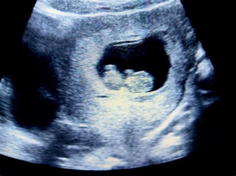 Ecografia di un feto di 10 settimane