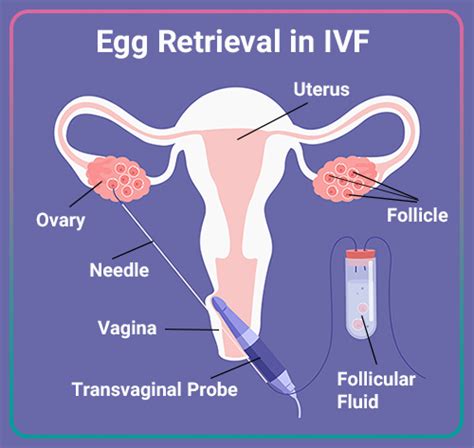 Diagram illustrating the process of egg retrieval in IVF