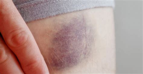 Bambino con emorragie sottocongiuntivali ed ecchimosi al volto causate dai violenti accessi di tosse