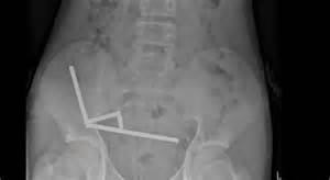 grafico che illustra la differenza tra magneti al neodimio e ciucci in silicone alimentare