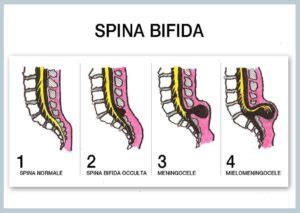 Chirurgia fetale per spina bifida