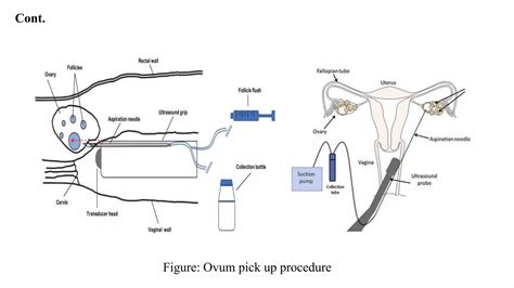 Schema del processo di ovum pick-up (OPU)