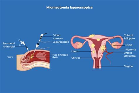 Immagine stilizzata che confronta la miomectomia isteroscopica e laparotomica