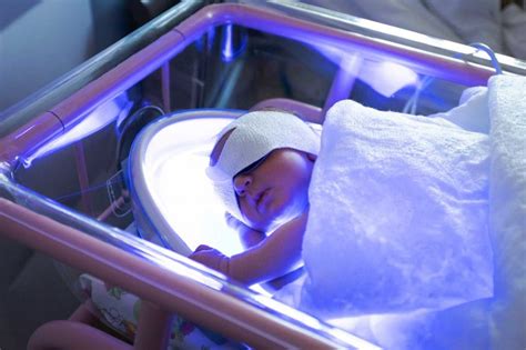 Neonato con ittero sotto fototerapia