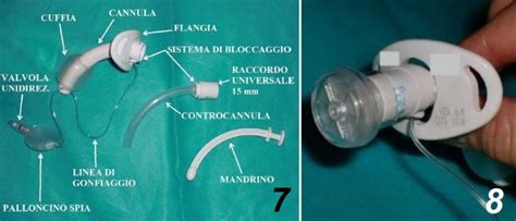 Cannula tracheostomica con valvola fonatoria