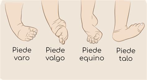 Confronto visivo tra piede torto congenito rigido e piede torto posizionale più flessibile