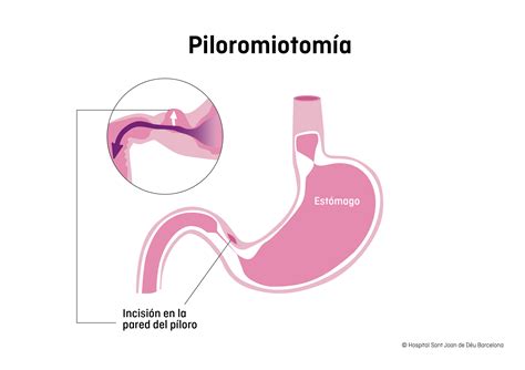 Schema della piloromiotomia
