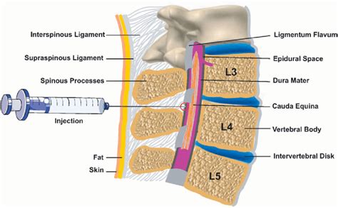 Diagramma dello spazio epidurale e della somministrazione dell'anestetico