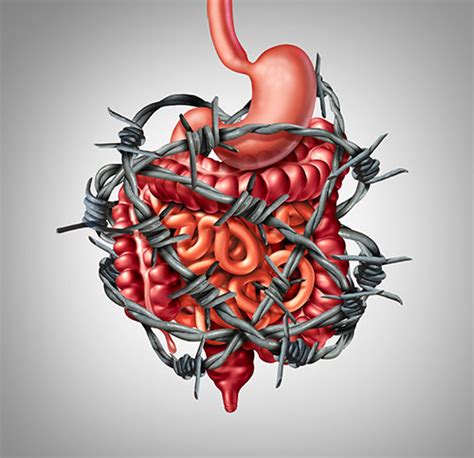 Diagramma che illustra come le aderenze possono causare un'ostruzione intestinale.