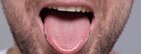 rappresentazione anatomica della macroglossia