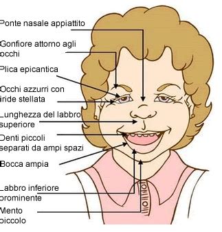 Facies tipica della Sindrome di Williams nei bambini