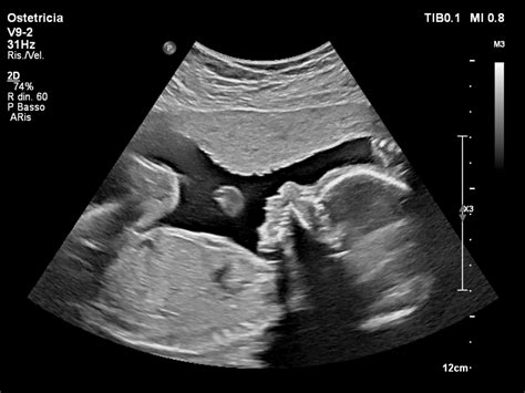 Ecografia fetale mostrando dettagli anatomici