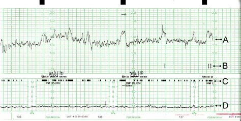 Illustrazione schematica di un monitoraggio cardiotocografico (CTG)