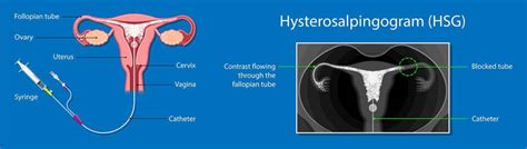 Hysterosalpingography with catheter for tubal recanalization