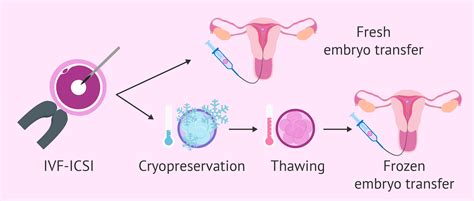 Embryo transfer