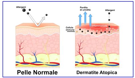 illustrazione di una pelle sana confrontata con una pelle atopica che mostra la barriera cutanea danneggiata e la perdita di idratazione