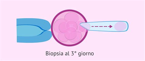 Comparazione tra biopsia al giorno 3 e al giorno 5