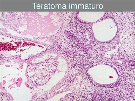 istologia di un teratoma immaturo che mostra neuroepitelio immaturo