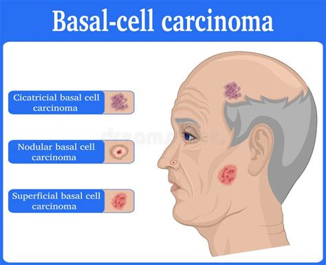 Illustrazione del Carcinoma Basocellulare