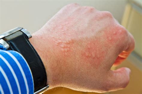 Dermatite da contatto causata dalla lanolina