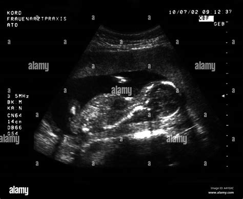Immagine ecografica di un feto in utero
