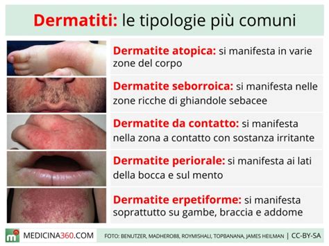 diversi tipi di dermatite da pannolino
