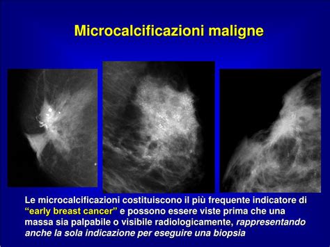Immagine comparativa di microcalcificazioni benigne e sospette