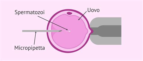 Rappresentazione grafica della precisione nell'iniezione ICSI