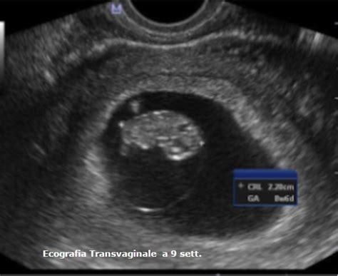 Ecografia transvaginale in gravidanza precoce